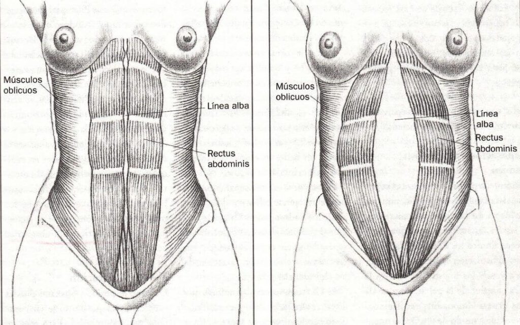 diastasis-abdominal-embarazo-foto