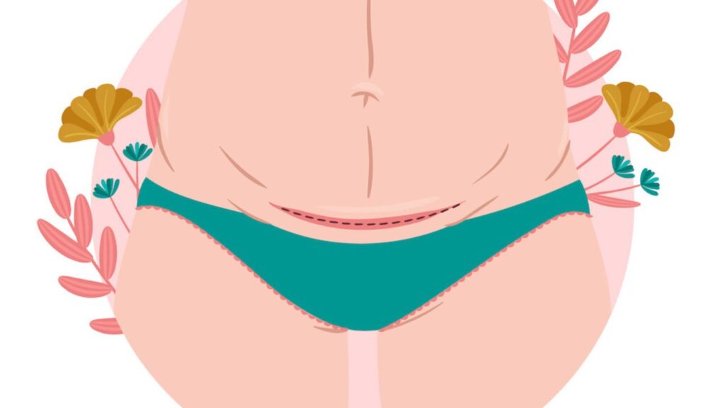 isioterapia-cicatriz cesarea