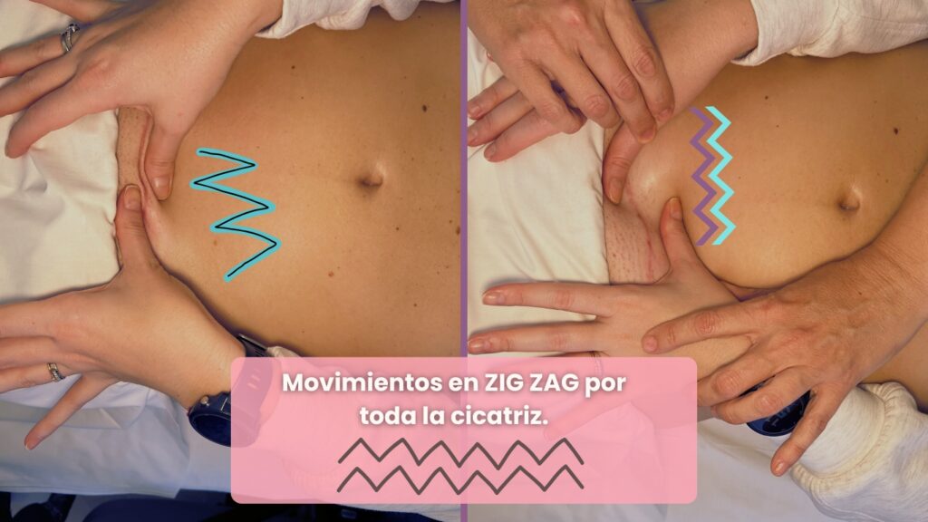 zig-zag-masaje-cicatriz-cesarea